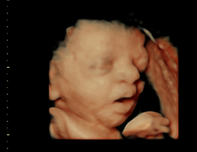 3D ultrasound image at 31 weeks